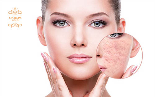  Dùng thuốc đông y ngâm rượu chữa sẹo rỗ dễ làm mỏng da.