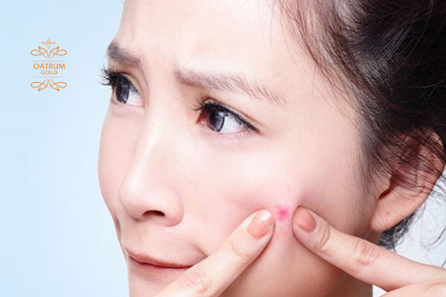  Nặn nhân mụn bên trong