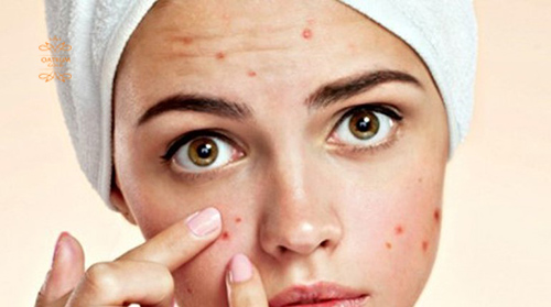  Hãy hiểu rõ làn da của mình để lựa chọn thuốc trị mụn bọc và vết thâm phù hợp