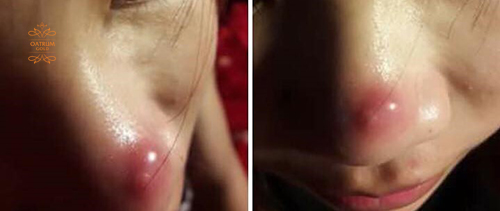  Mụn bọc sưng viêm là do vi khuẩn P.acnes gây ra