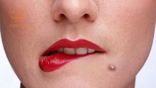 Mụn bọc ẩn dưới da là do nội tiết tố hoặc yếu tố di truyền