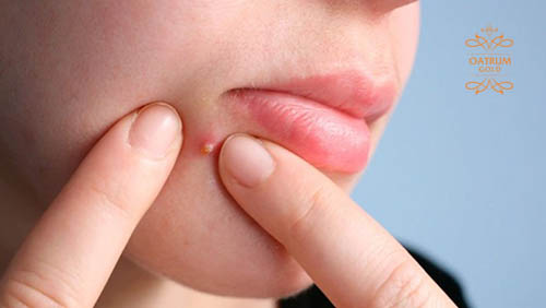 Tuyệt đối không được dùng tay nặn mụn bọc khi đang sưng to.