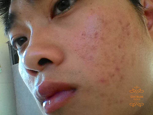  Sự thay đổi nội tiết tố dễ hình thành nên mụn đầu đen.