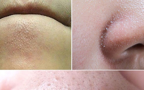 Mụn đầu trắng thường hình thành ở các vị trí tiết nhiều dầu thừa.