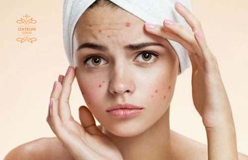  Mụn bọc có nhân sâu bên trong nên rất khó khăn khi điều trị.