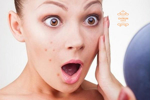  Chăm sóc da không đúng cách khiến mặt nổi nhiều mụn bọc