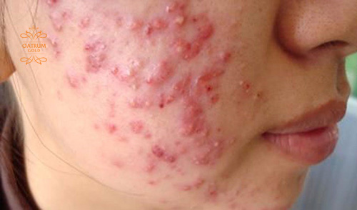  Có nhiều nguyên nhân khiến mặt tự nhiên nổi nhiều mụn bọc