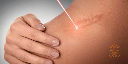  Thận trọng khi điều trị sẹo lồi bằng thủ thuật.