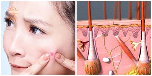 Mụn bọc bị chai là mụn lâu năm, nhân trong mụn đã trở nên đông cứng, khó điều trị.