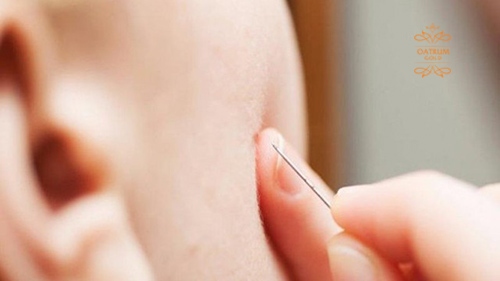  Dùng kim chích nặn mụn bọc không đầu là phương pháp phổ biến