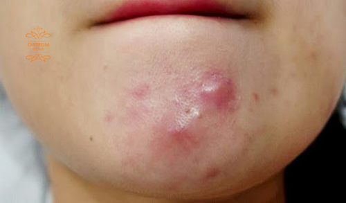 Mụn bọc không đầu có nhân ẩn sâu dưới các lớp da