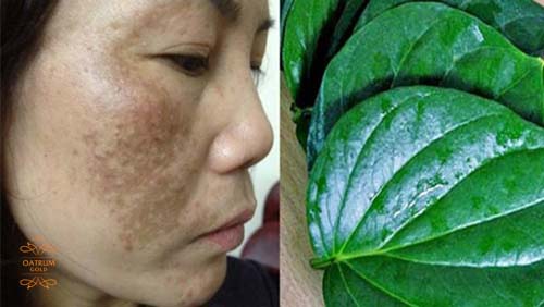 Kết hợp giữa muối và lá trầu không giúp xoá mờ nám da hiệu quả.