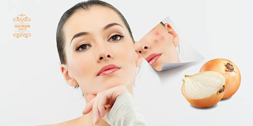 Tinh chất hành tây giúp sản sinh collagen để làm đầy sẹo.