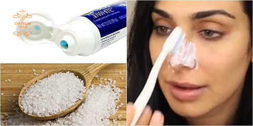 Trị mụn đầu trắng bằng kem đánh răng và muối.