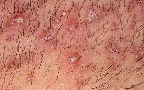 Mọc mụn bọc ở vùng kín có thể là dấu hiệu của bệnh viêm nang lông