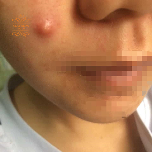  Mụn bọc không có nhân thường có kích thước lớn, gây sưng đau