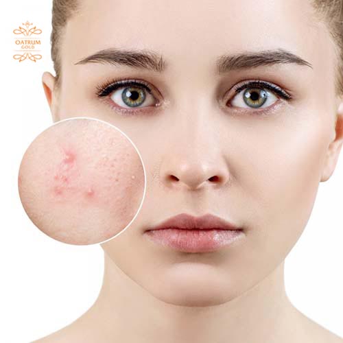 Mụn bọc không đầu có nhân ở sâu dưới da, gây đau và khó điều trị.