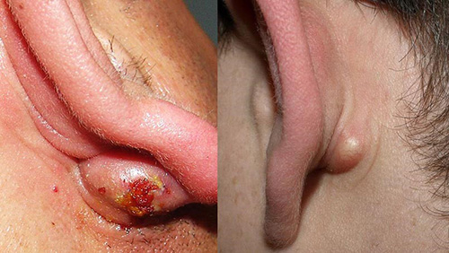  Mụn bọc ở vành tai do nhiều nguyên nhân gây nên