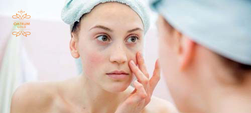  Mụn đầu đen tuy không sưng đau nhưng lại rất cứng đầu.