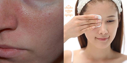 Tẩy trang không kỹ khiến da mọc nhiều mụn đầu trắng.