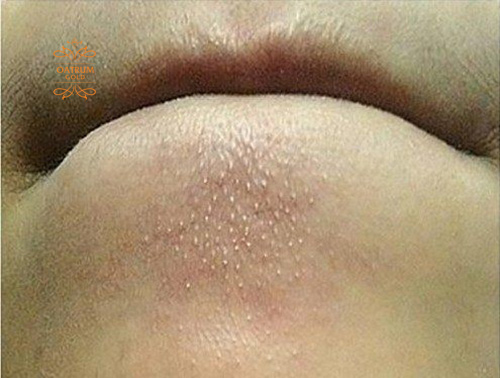 Không nên nặn mụn đầu trắng vì có thể khiến mụn sưng viêm.