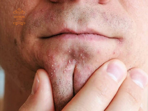 Sự tăng tiết bã nhờn khiến da nổi nhiều mụn đầu trắng.