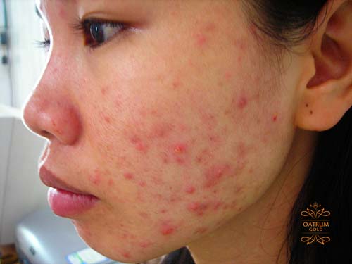 Mụn trứng cá đỏ thường có triệu chứng giãn mạch, bốc hoả, ngứa ngáy và sưng đỏ.