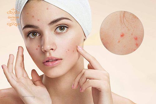 Mụn trứng cá hình thành chủ yếu do bít tắc lỗ chân lông.