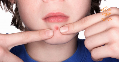 Mụn trứng cá ở cằm xuất phát từ nhiều yếu tố bên trong và bên ngoài cơ thể.