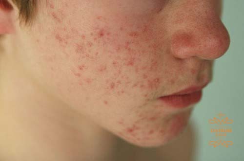    Mụn trứng cá được hình thành do tuyến bã nhờn hoạt động quá mức.