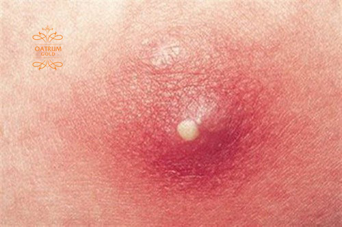  Mụn bọc ở mông là vị trí nhạy cảm, gây đau đớn, khó chịu