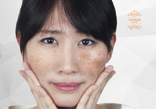 Nám da chủ yếu là xuất hiện ở vùng má, đối xứng 2 bên gò má.