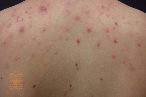 Mụn trứng cá ở lưng khó điều trị hơn so với mụn trứng cá ở mặt.