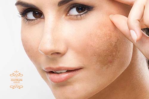    Ăn uống đúng cách sẽ giúp đẩy lùi nám da hiệu quả.