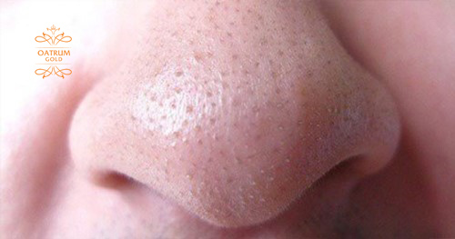 Mụn đầu trắng chủ yếu xuất phát từ sự tăng tiết bã nhờn trong cơ thể.