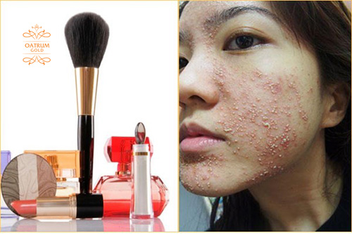 Dị ứng mỹ phẩm cũng là nguyên nhân mụn đầu trắng.