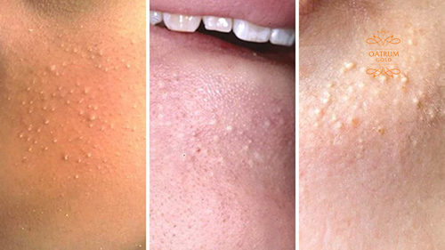 Mụn đầu trắng thường xuất hiện tại các vị trí đổ nhiều dầu thừa.