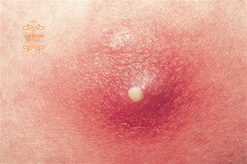    Mụn bọc ở háng thường có kích thước lớn, gây đau đớn