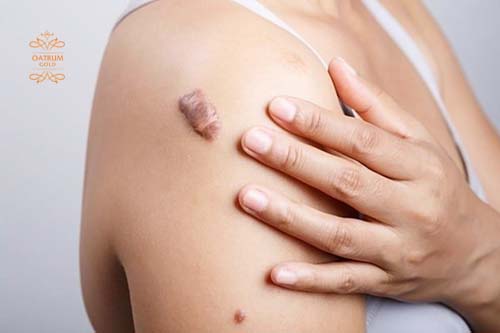 Sẹo lồi thường gây cảm giác ngứa ngáy, có khi đau và căng cứng.