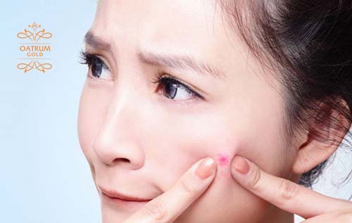 Tự ý nặn mụn rất dễ gây ra sẹo lõm trên khuôn mặt.