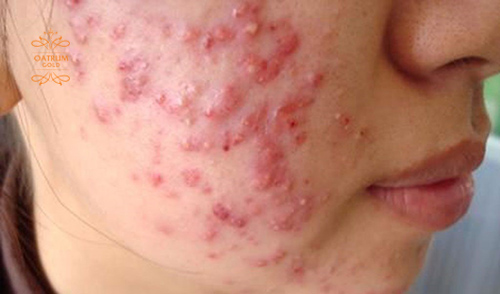 Mụn bọc là thể nặng của mụn trứng cá