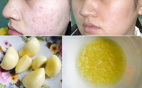 Tỏi giúp chống oxy hóa, loại bỏ các tác nhân gây mụn