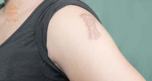 Sẹo lồi lâu năm rất cứng đầu nên điều trị cũng khó khăn hơn nhiều.