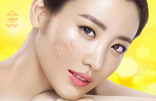  Sẹo lõm lâu năm ở mặt không chỉ gây mất thẩm mỹ mà còn rất khó điều trị.