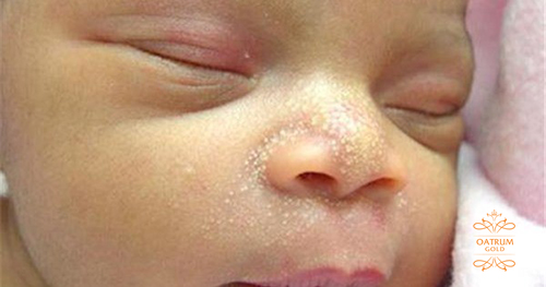 Mụn sữa có thể do mẹ truyền sang con trong quá trình mang thai.