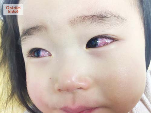  Kết mạc của trẻ bị sung huyết là một trong những dấu hiệu của bệnh Kawasaki