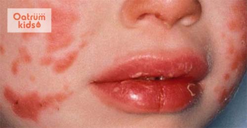  Bệnh Kawasaki thường xuất hiện ở trẻ dưới 5 tuổi