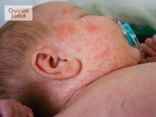  Các nốt, chấm, mảng bầm máu tụ là biểu hiện của bệnh giảm tiểu cầu