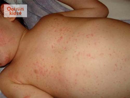  Có nhiều nguyên nhân dẫn đến bệnh giảm tiểu cầu ở trẻ em