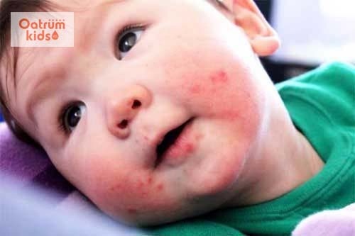  Khi trẻ bị tay chân miệng cần theo dõi sát sao 